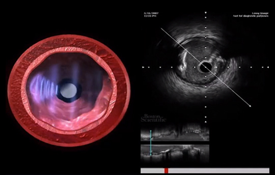 Introduction to IVUS (1 CE credit) course image