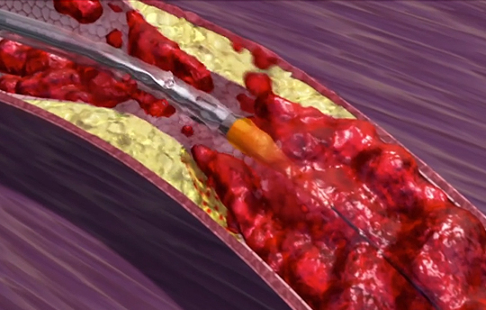 Coronary Thrombectomy Treatment Strategies (0.25 CE credits) course image