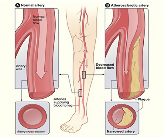 Foundations of SFA & BTK Interventions (2.5 CE credits) course image