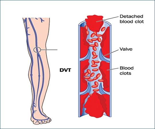 Foundations of Venous Interventions (3.25 CE credits) course image