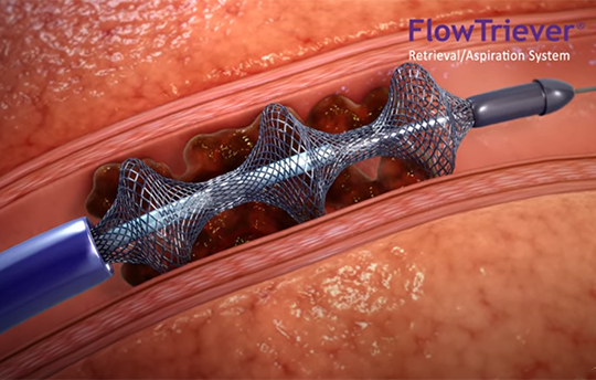 FlowTriever Retrieval / Aspiration System Case Study course image